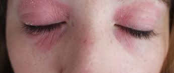 Eczema Around Eyes Or Atopic Dermatitis
