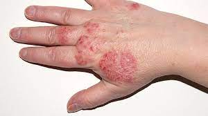 Eczema Flare-ups