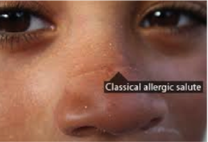 Allergic Rhinitis Symptoms